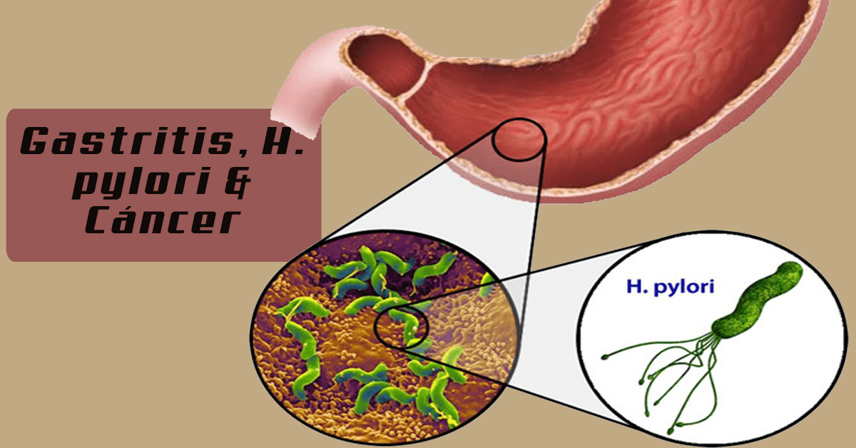 Sintomas del helicobacter pilory